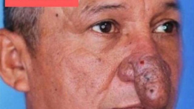 ST4.The Remarkable Transformation of Conrado’s Nose