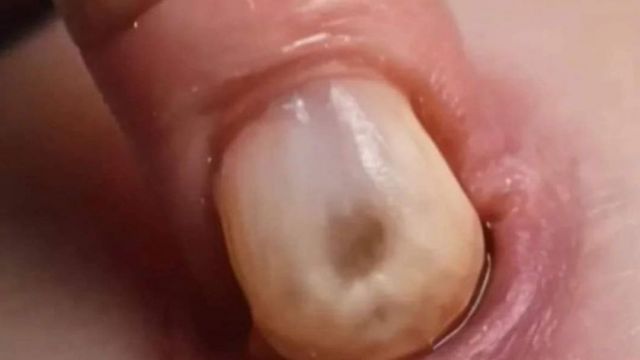 ST4, What White Tongue Is, and What to Do About It