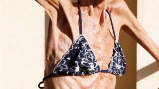 ST4.The World’s Thinnest Woman’s Battle Against Anorexia Will Leave You Speechless!