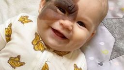 HT4. Parents’ Love Drives Them to Remove Daughter’s Birthmark