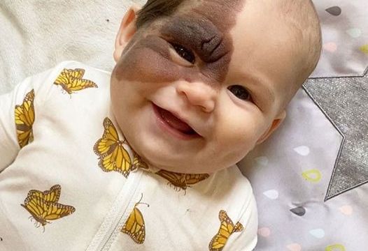 HT4. Parents’ Love Drives Them to Remove Daughter’s Birthmark