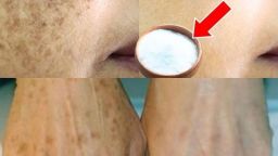 HT1.  Erased My Age Spots With a Cheap Kitchen Ingredient — Baking Soda Paste