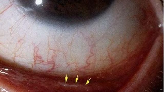 ST1. Doctor Shudders as 15cm Long Worm is Removed from Patient's Eye